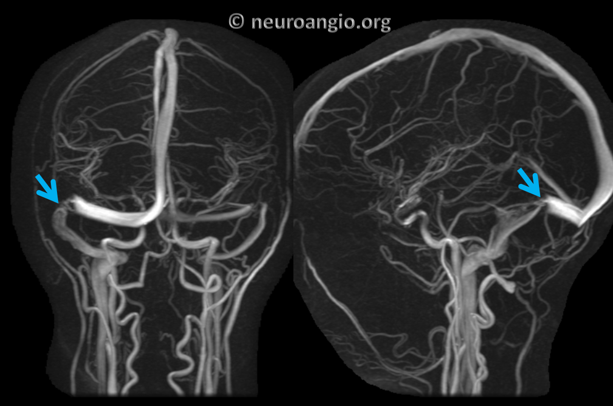 pulsatile-tinnitus-venous-sinus-stenosis-neuroangio